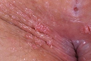 kondilomiostrokonechnie119-foto.jpg
